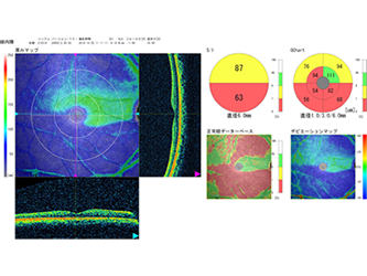 測定結果の一例（緑内障）